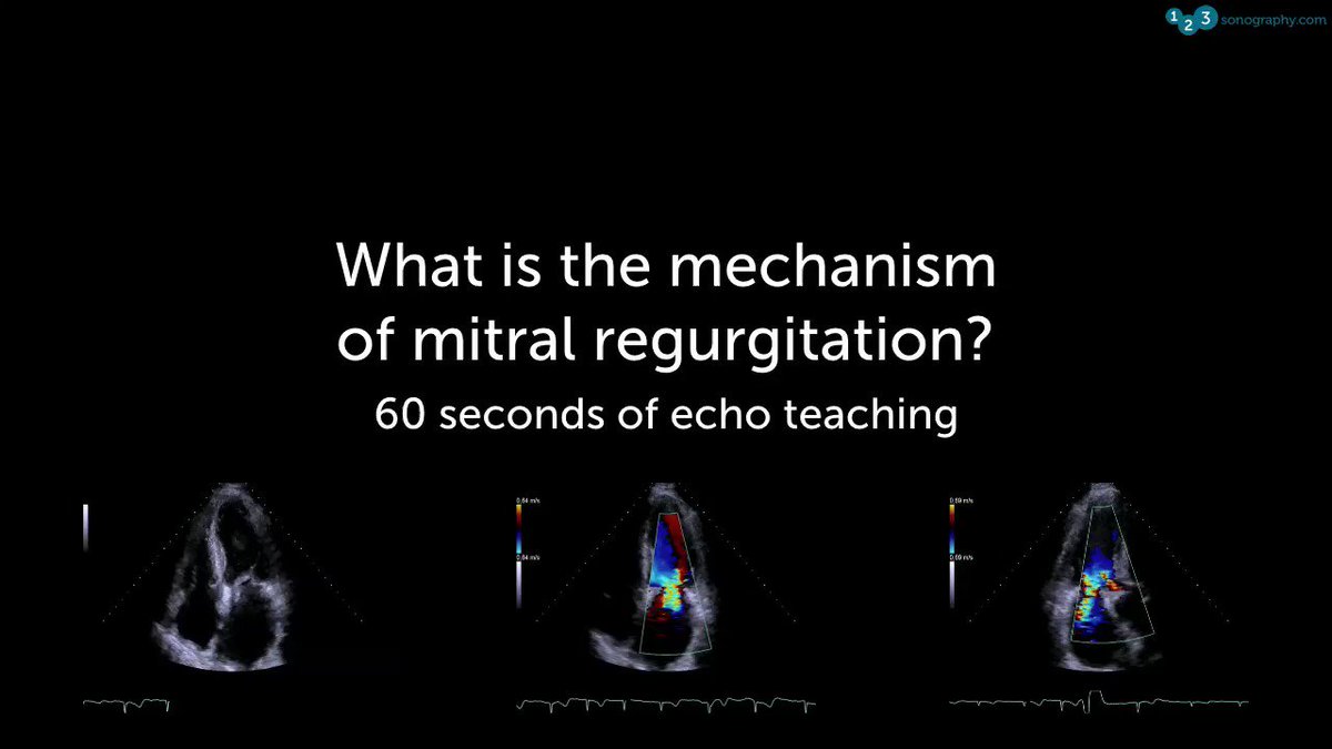 60 Seconds of Echo Teaching Question: Do you know what the mechanism of MR is in this patient? Tweet us what you think.
Take a look at our courses & start with our free lectures: https://www.123sonography.com/echo-ultrasound
#Echocardiology #eLearning #MedicalUltrasound