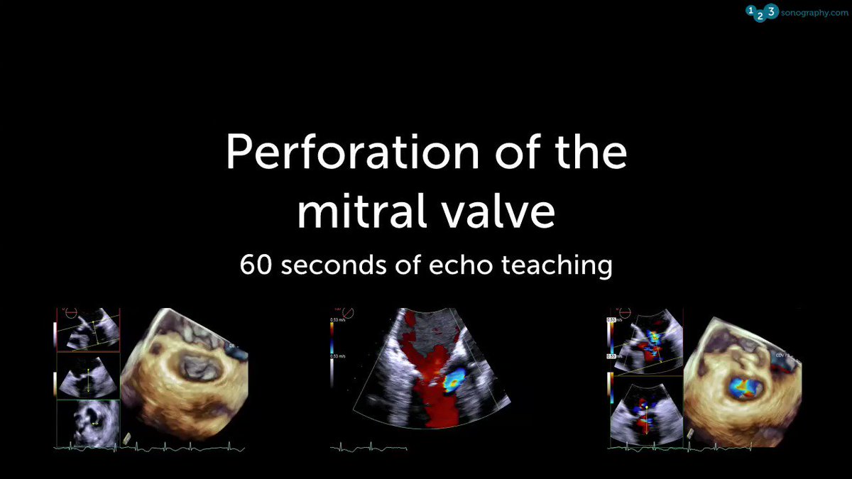 60 Seconds of Echo Teaching Answer: The problem is perforation of the anterior leaflet. The patient had AV endocarditis, which resulted in AR.
#Echocardiology #eLearning #MedicalUltrasound