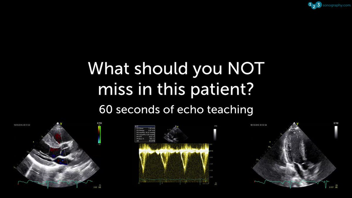 60 Seconds of Echo Teaching Question: What should you look for in this patient with an abnormal ECG, dyspnea and mild peripheral edema?
View our courses that we have to offer: https://www.123sonography.com/echo-ultrasound
#Echocardiology #eLearning #MedicalUltrasound