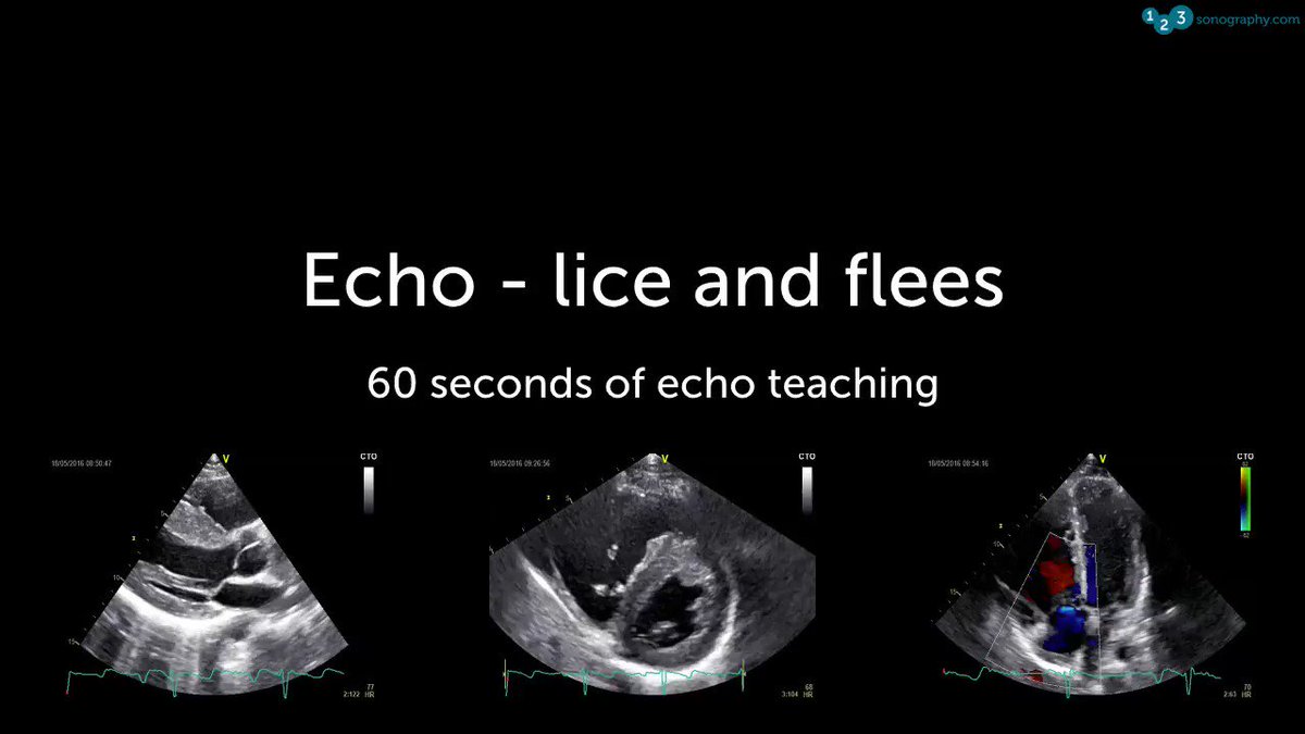 60 Seconds of Echo Teaching Answer: The patient not only has HNOCMP but also a ASD II.
#Echocardiology #eLearning #MedicalUltrasound