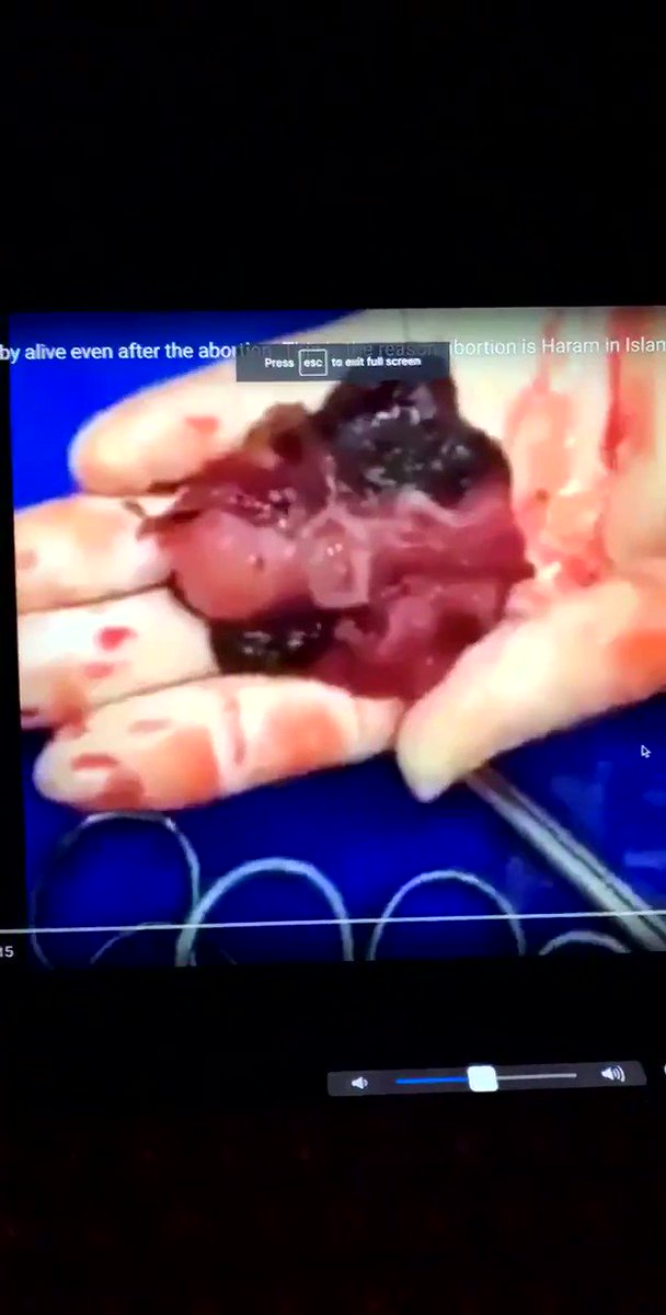 This baby is 12 weeks into fetal development and is clearly fighting for their life. Donβt tell me abortion isnβt murder.