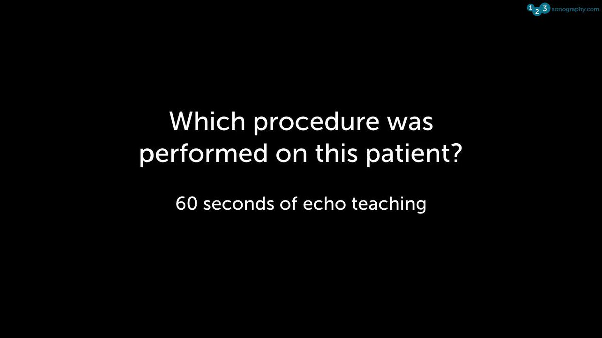 60 Seconds of Echo Teaching Question: Can you tell which procedure was performed on this patient?
▶️ Have you seen our diploma course? Sign up here: https://www.123sonography.com/echo-ultrasound
#Echocardiology #eLearning #MedicalUltrasound