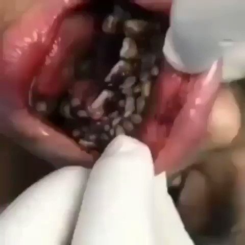 miasis genital en humanos