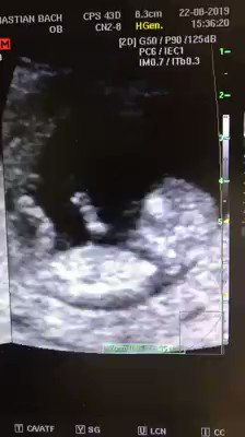 El Mag.Linares quiere legalizar el asesinato de Bebés de 12 semanas de gestación como este hermoso que juega a la resbaladilla en el vientre de su madreEso todavía no es un ser humano...dicenEs mi cuerpo y mi decisión...dicen#AbortoSinCondiciones..dicen