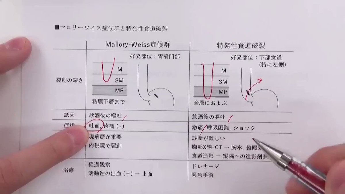 マロリー ワイス マロリー ワイス症候群 食道 胃 腸の病気 分類から調べる 病気を調べる 病気解説2600項目 根拠にもとづく医療情報の提供 家庭の医学 大全科