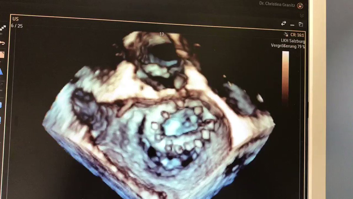 ChristinaGranitz (@C_Granitz) on Twitter photo 18/01/2020 18:08:44 @lpbadano I found a case of mitral ring dehiscence to commemorate the occasion 𤩠@lpbadano I found a case of mitral ring dehiscence to commemorate the occasion š¤©