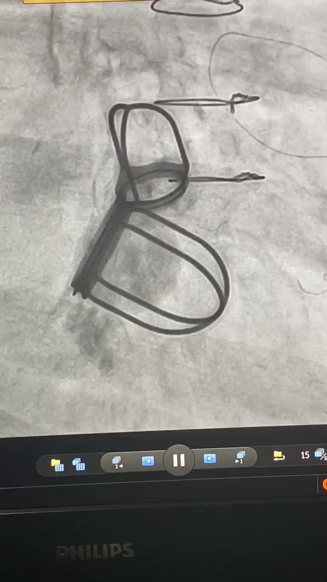 Mayara Viana (@MayaraV77647721) on Twitter photo 17/02/2020 18:34:38 Case: Starr-edwards Ball Valve Heart Prosthesis Case: Starr-edwards Ball Valve Heart Prosthesis