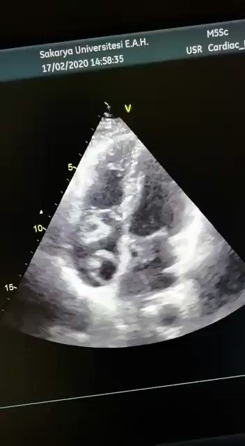 What is ur diagnosis? @_kayaesra_ @ecocardio_cl @lpbadano @PezelT @argulian #cardiotwitter #Cardiology #Echofirst #Euroecho