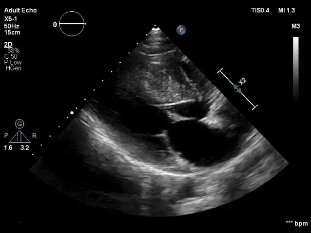 Parag Bawaskar | डॉ.पराग बावस्कर (@paragbawaskar) on Twitter photo 24/02/2020 23:42:13 Young male with Dyspnea. #echofirst @ASE360 Young male with Dyspnea. #echofirst @ASE360