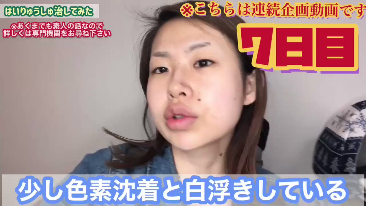 セトセイラ 稗粒腫 はいりゅうしゅ 保険適用施術の料金やおすすめの皮膚科をご紹介します こちらの動画は後編です 顔にある白いぷつぷつって保険適用の施術で簡単に治してもらえるんですよ という訳で 実際に治してもらってきたので事細かにご紹介し セトセイラ 稗粒腫 はいりゅうしゅ 保険適用施術の料金やおすすめの皮膚科をご紹介します こちらの動画は後編です 顔にある白いぷつぷつって保険適用の施術で簡単に治してもらえるんですよ という訳で 実際に治してもらってきたので事細かにご紹介し