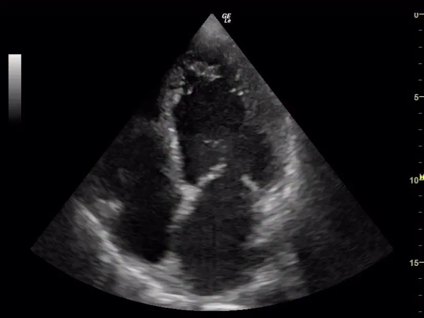 NephroPOCUS on X: This #POCUS finding can be missed on foreshortened  images. In addition to adjusting the imaging plane to transect the LV apex,  get other views to demonstrate the pathology (e.g.