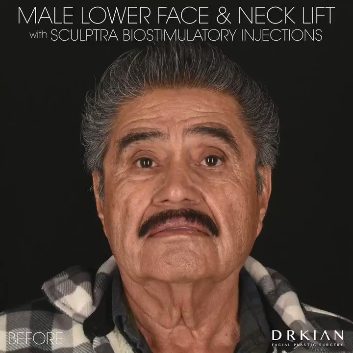 Having considered cosmetic procedures over the years to look his best for his wife of 50 years, this patient was hesitant to move forward with an invasive surgery out of concern that his results might appear unnatural or he would have a ‘pulled’ look from going under the knife. https://t.co/Pvjl5k6ds0