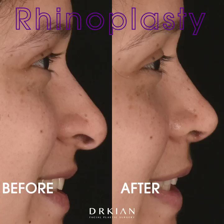 Tiana has suffered nearly a lifetime of bullying in almost every phase of her life for the appearance of her nose. I’m grateful for the opportunity to help her move on with her life & can’t wait to share her full #Rhinoplasty transformation with you in the coming weeks. https://t.co/bVau1iD7D0