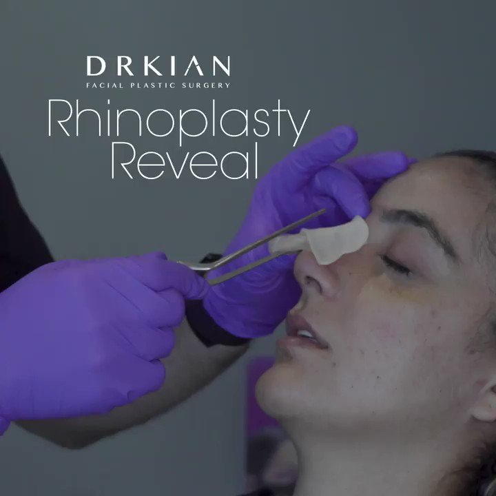 "If I’m this happy today, I can’t imagine how happy I’m going to be in a week!”
#rhinoplasty #rhinoplastybeforeandafter #nosebydrkian https://t.co/lYr7Gl6q61