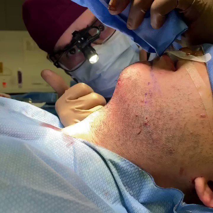 NEW VIDEO: Neck Liposuction + Fat Transfer to Chin.
This is one of my favorite procedures to perform and takes only about an hour and a half. #ChinAugmentation #FatTransfer #PlasticSurgery https://t.co/xuJ1LtVwCz