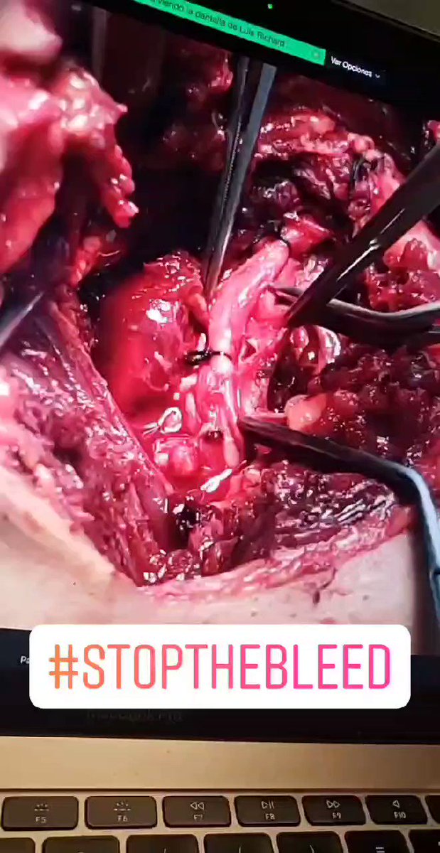Interesados en conocer sobre #sangrados, #controldedaños y más temas de #Cirugia de #trauma, invitados a seguir la cuenta del @drluisrichard ✋ https://t.co/q6X68mhmKH