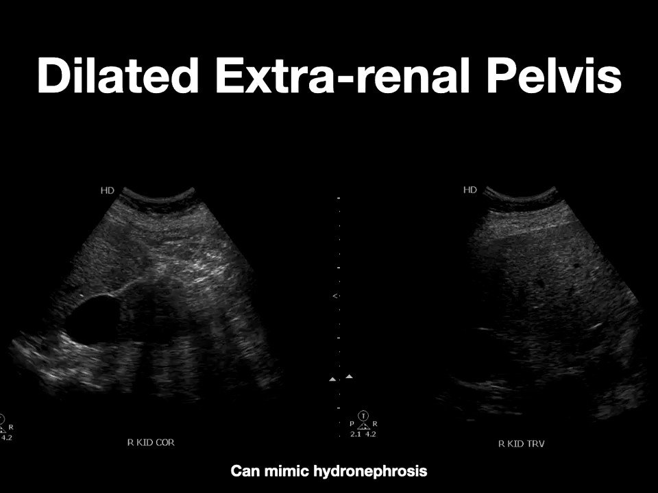Extrarenal Pelvis extrarenal-pelvis