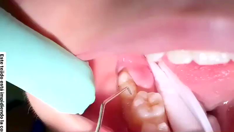 Tukanggigi Najib S Tweet Kes Ni Biasa Bila Gigi Bongsu Baru Nak Tumbuh Cuba Teka Apa Nama Tisu Lembut Yang Dibuang Tu Credit Drg Alina Quintero Trendsmap