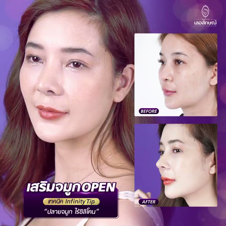 โรงพยาบาลเลอลักษณ์ ศัลยกรรมตกแต่ง on Twitter: โรงพยาบาลเลอลักษณ์ ศัลยกรรมตกแต่ง On Twitter: