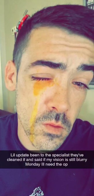 Lil update on day 4, been to the specialist who has cleaned my eye out and said to give it to Monday