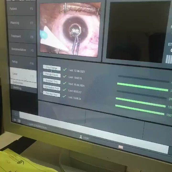 الاستشاريون لطب العيون On Twitter زراعة الحلقات هي حل جراحي بسيط لعلاج القرنية المخروطية توقف المرض وتحسن الرؤية لا تغني عن النظارة ولكنها تقلل الحاجة إليها تتم خلال دقائق