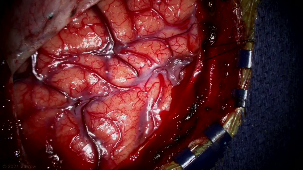 Who says you can’t safely remove cavernous malformations below speech/language areas?
The lateral sulcus, or distal Sylvian fissure, is an amazing corridor that opens like a staircase along M4 cortical to M3 opercular to M2 insular arteries to reach insula and lateral thalamus. https://t.co/epVS0qAG2m