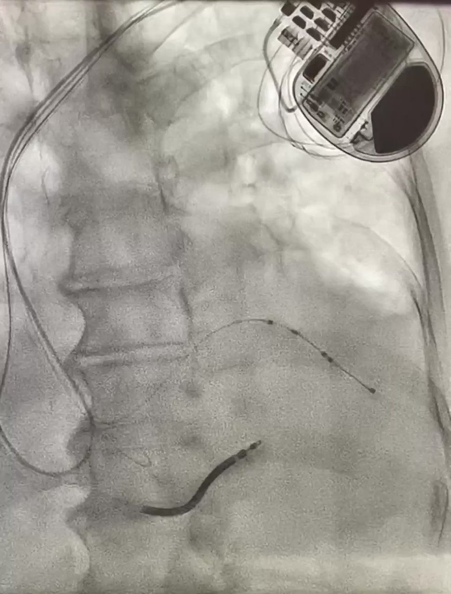 Appreciating the #Medtronic #Attain Stability Quad 4798 LV lead for #CRT. A great tool for added stability. #Epeeps @MDT_Cardiac https://t.co/xgpktr1iYy