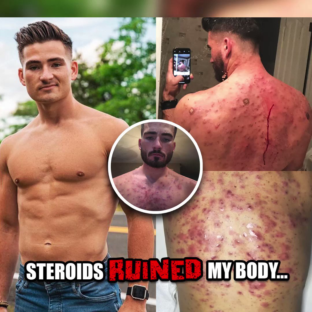 More Plates More Dates on Twitter ""FIRST STEROID CYCLE How it ruined my body" In todays