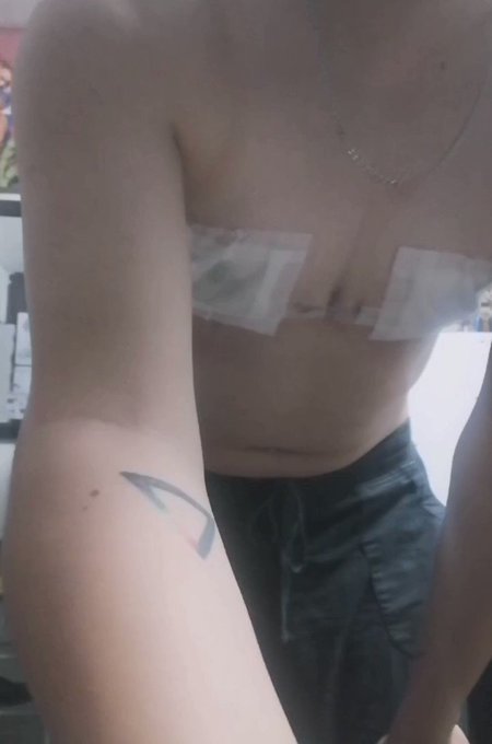 Im so happy with the way my chest turned out! Here's a vid of me just enjoying it after changing my bandages
