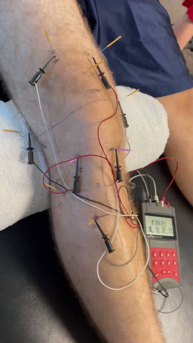 Electric Dry Needling, Fort Worth, TX - ClearCut Ortho