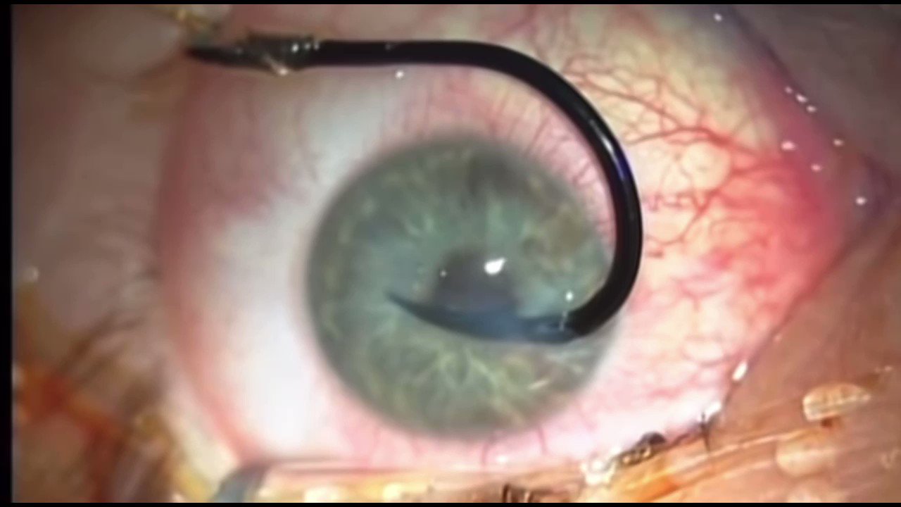 Oren Gottfried, MD on X: Who has a fear of getting something stuck in  their eye? See safe removal of a fish hook injury. Source: Juan Navarro.   / X