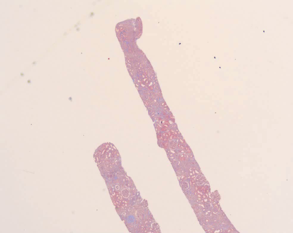 原発性膜性腎症の治療法は何ですか?