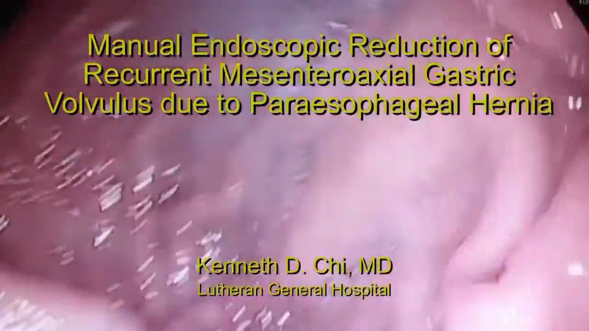 Keith Siau on Twitter "Endoscopic detorsion of a gastric volvulus 