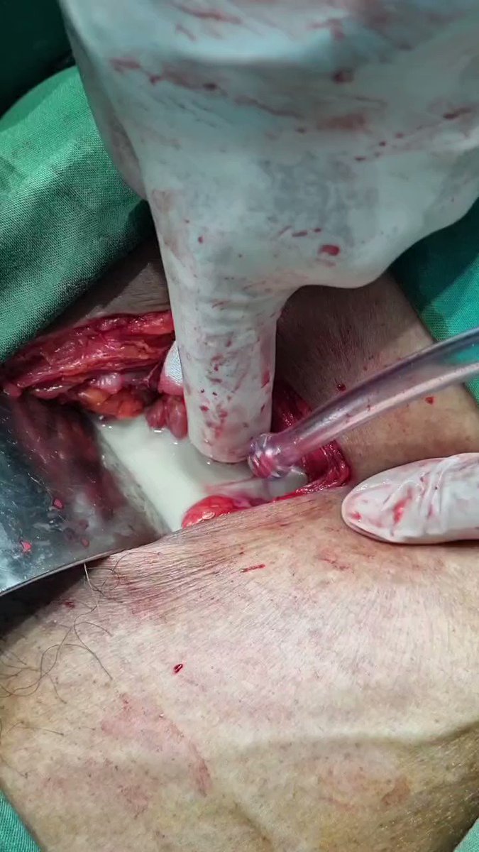 Bismillaah...
Suatu ketika ada pasien datang dengan keluhan nyeri di pinggang. Keluhan dirasakan sud...