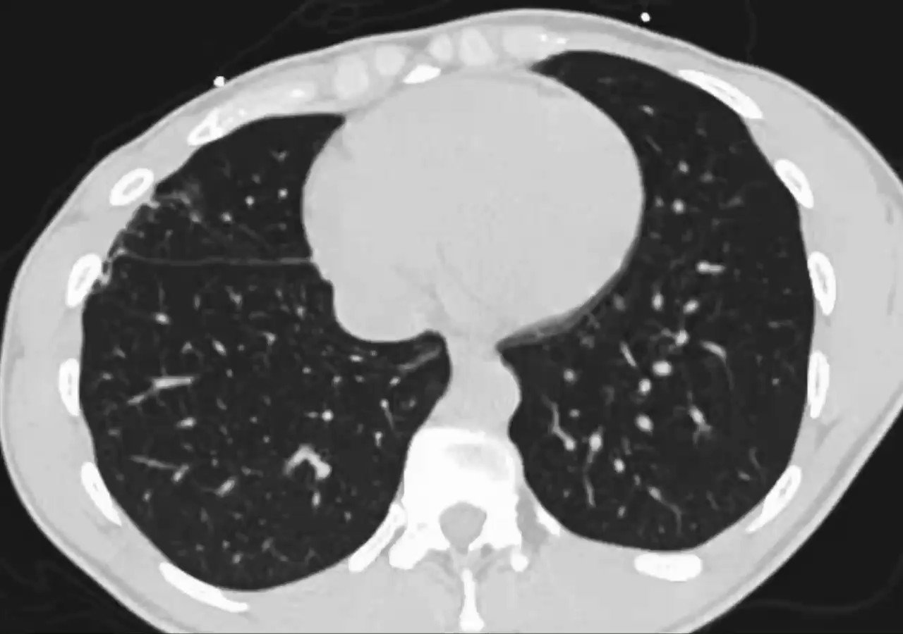 dr-khaled-ahmed-abuzeid-on-twitter-post-primary-tb-typical-location