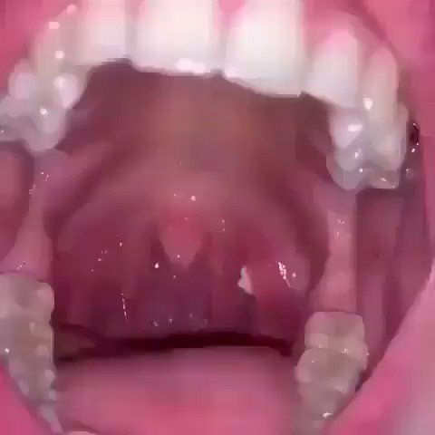 tonsil stone removal