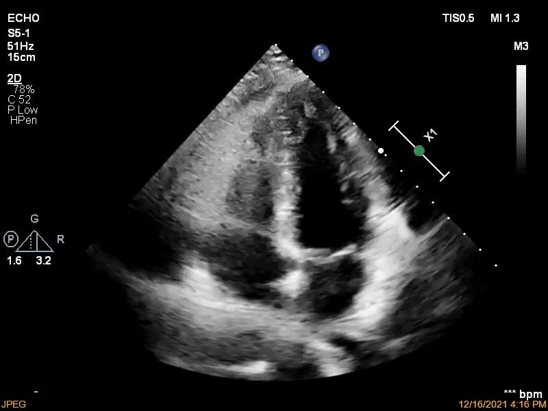 JACC Journals on Twitter "35 y/o woman w/ history of CVD presented w