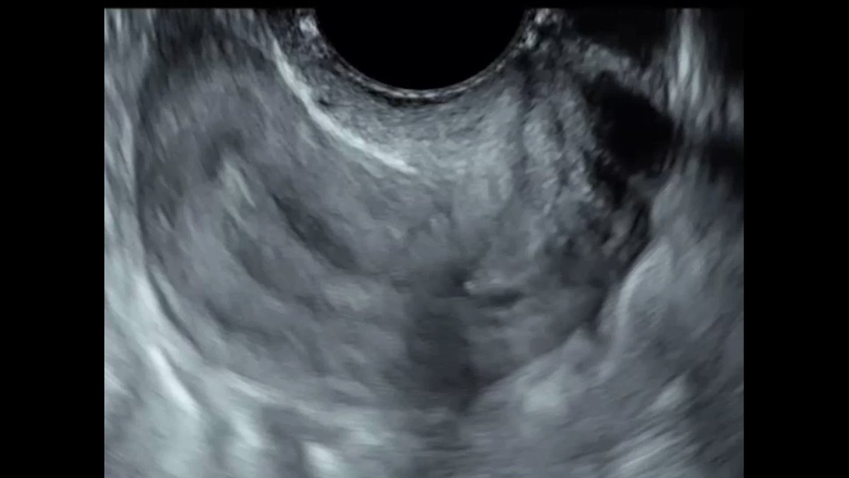 Gynecologic Ultrasound Society of North America on Twitter "SLIDING