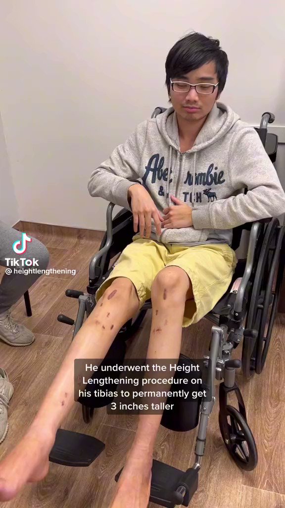 on-twitter-his-legs-look-like-what-a-lifelong-wheelchair-bound
