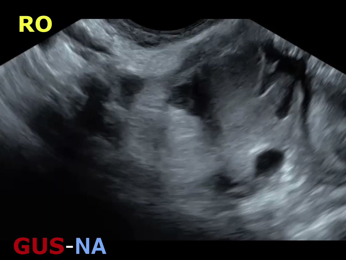gynecologic-ultrasound-society-of-north-america-on-twitter