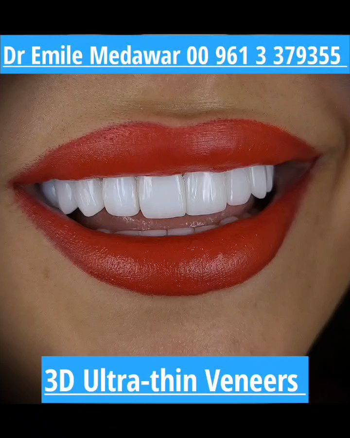 Ultra-Thin #DentalVeneers 
Great #HollywoodSmile Laser  #DentalImplants
#Dentist Dr #EmileMedawar #DentalImplants Surgeon #Lebanon #Beirut 961 3 379355
#HollywoodSmile #GummySmile #PorcelainVeneers #DirectVeneers #Zirconium #Teeth
emile_medawar@hotmail.com
https://t.co/g05w0YKWg7 https://t.co/gU2BJa1L8N