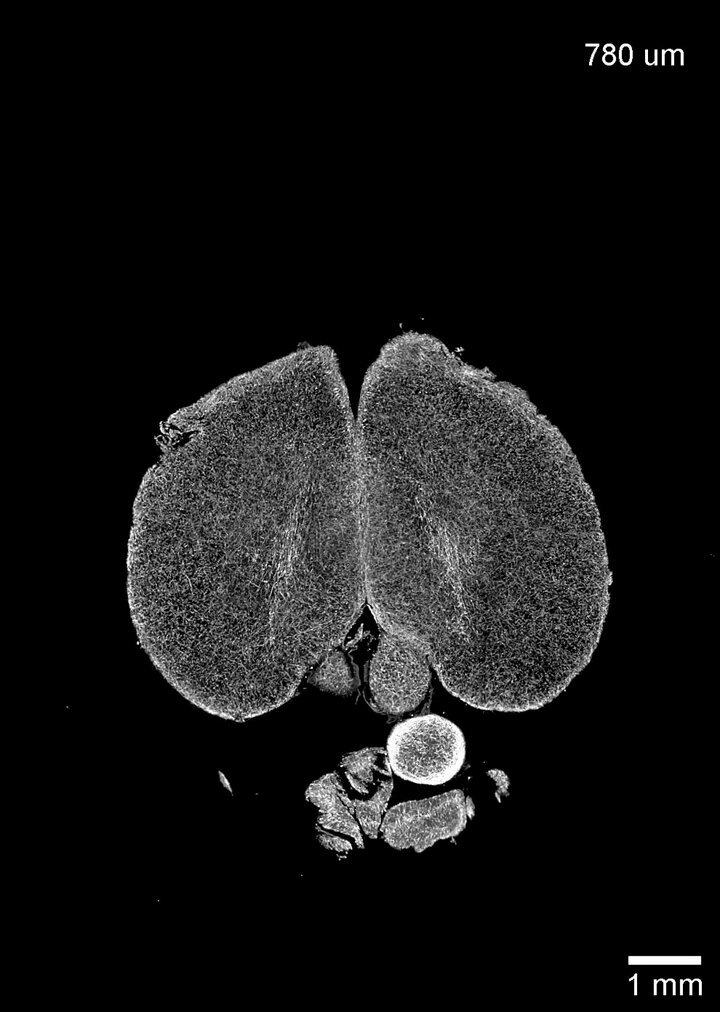 Negative Emotions Recruit the Parabrachial Nucleus Efferent to the VTA to  Disengage Instrumental Food Seeking