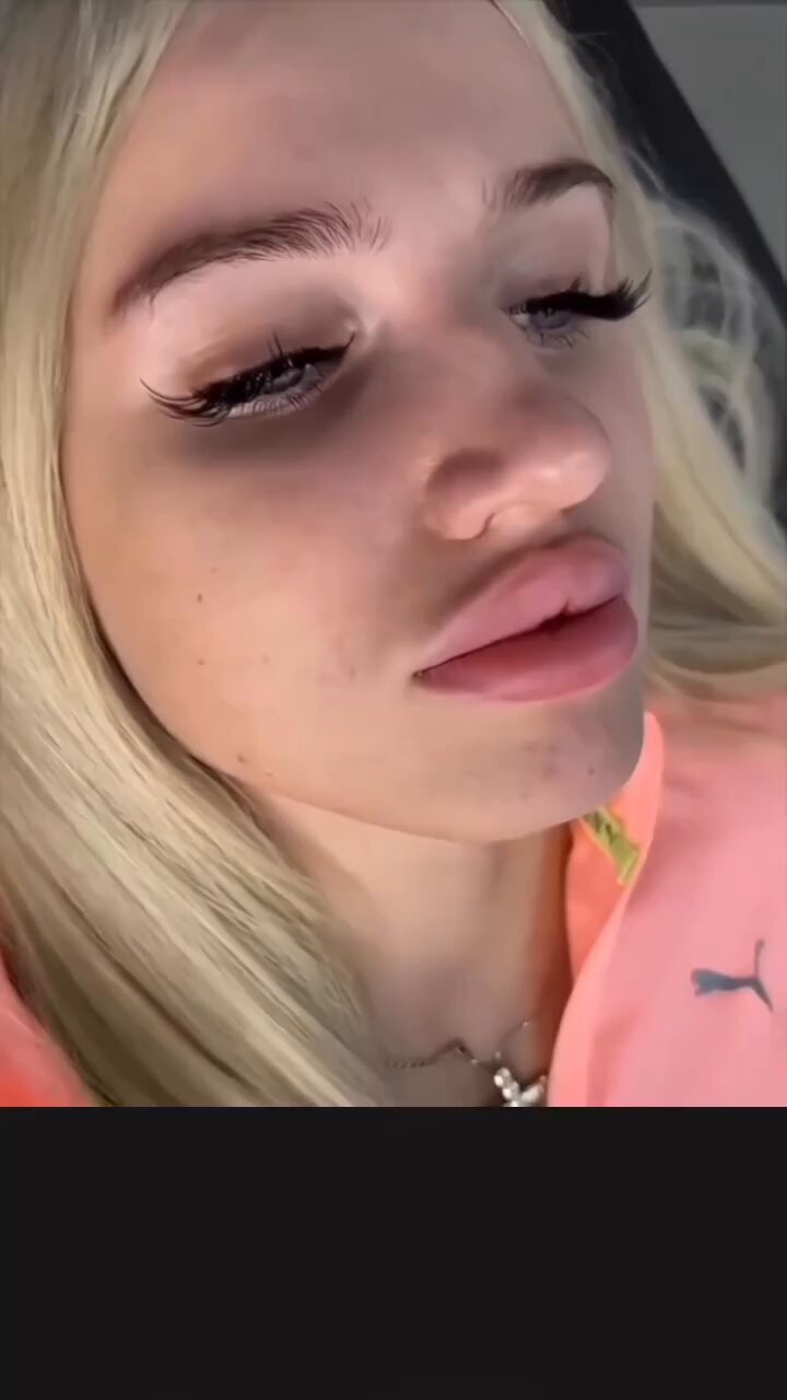 たらこ唇 Plastic surgery] Improving lips [Progression photos] - YouTube