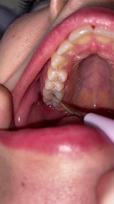 VID SOLD! Ultrasonic teeth cleaning. Teeth fetish 🔥 Check it out! https://t.co/XqWlu94sbI #MVSales @manyvids<a href="/tag/mvsales"class="tags"><span>#mvsales</span></a>