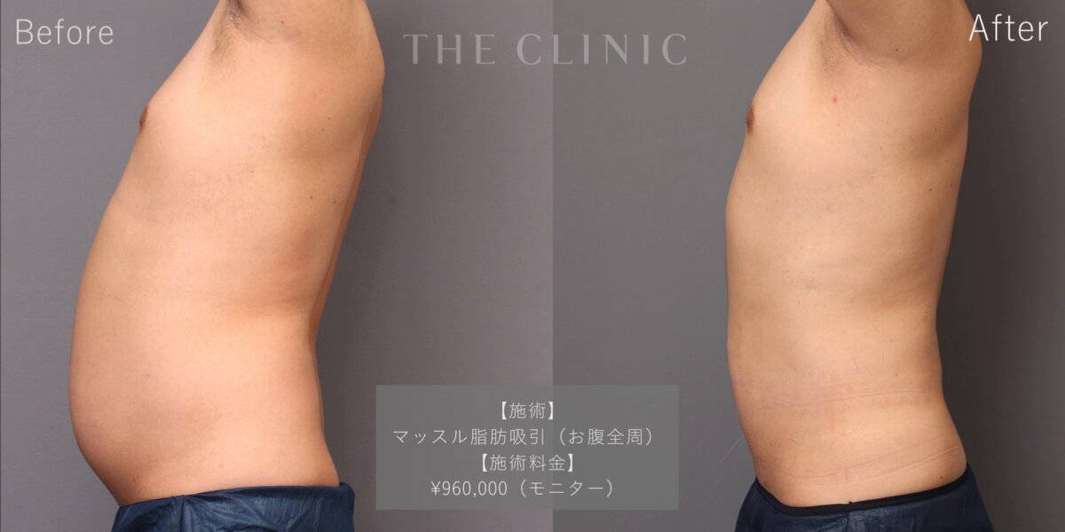 美品】THE CLINIC ザクリニック脂肪吸引 圧迫着 お腹・腰