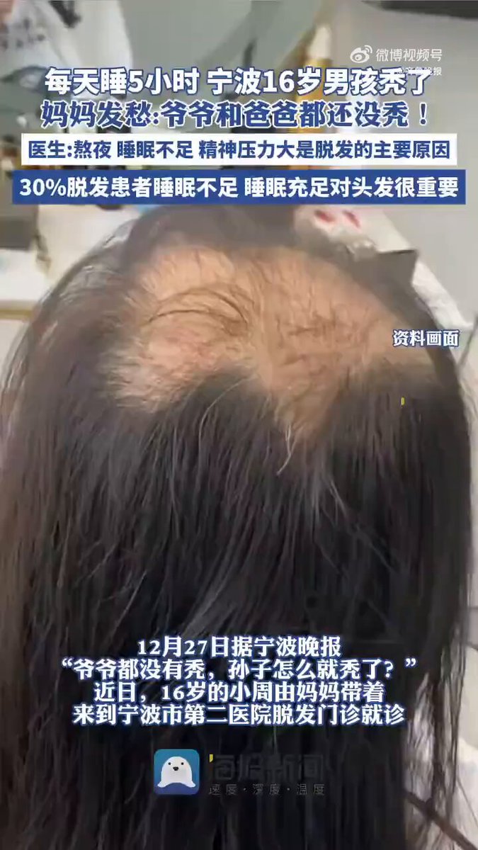 16岁男孩每天只睡5小时头先秃了
近日，浙江宁波，16岁的小周由妈妈带至医院脱发门诊就诊，小周的妈妈纳闷，家里没有脱发基因，小周的爷爷70岁了，头发还算茂盛，小周的爸爸45岁了，也没脱发。
小周小小年纪怎么就秃了？了解小周的生活起居后，医生认为，小周的情况属于休止期脱发。 