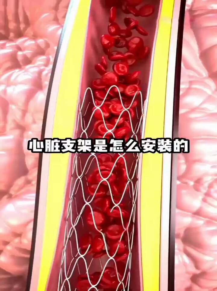 「心脏支架是如何植入到人体内部的？」

支架是一种微型的、可膨胀的金属线圈，插入新打开的动脉部位，以帮助防止动脉再次狭窄或闭合。 放置支架后，手术后几天内组织就会开始在支架上形成。