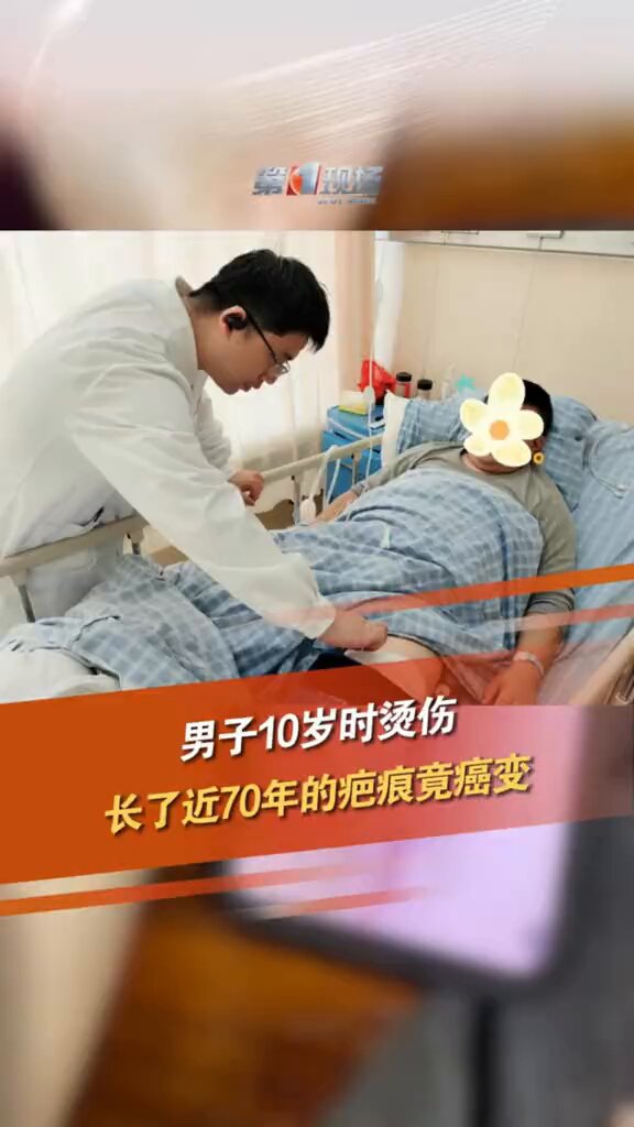 1月9日 浙江宁波男子10岁时不慎烫伤左小腿留疤，然而就在5年前，它开始反复破溃、渗出。医检查后结果竟提示疤痕有癌变 