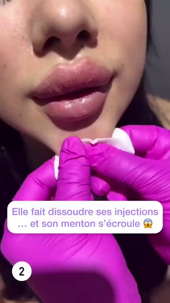 تآكل عظام الفك لدى سيدة بعد إذابة الفيلر