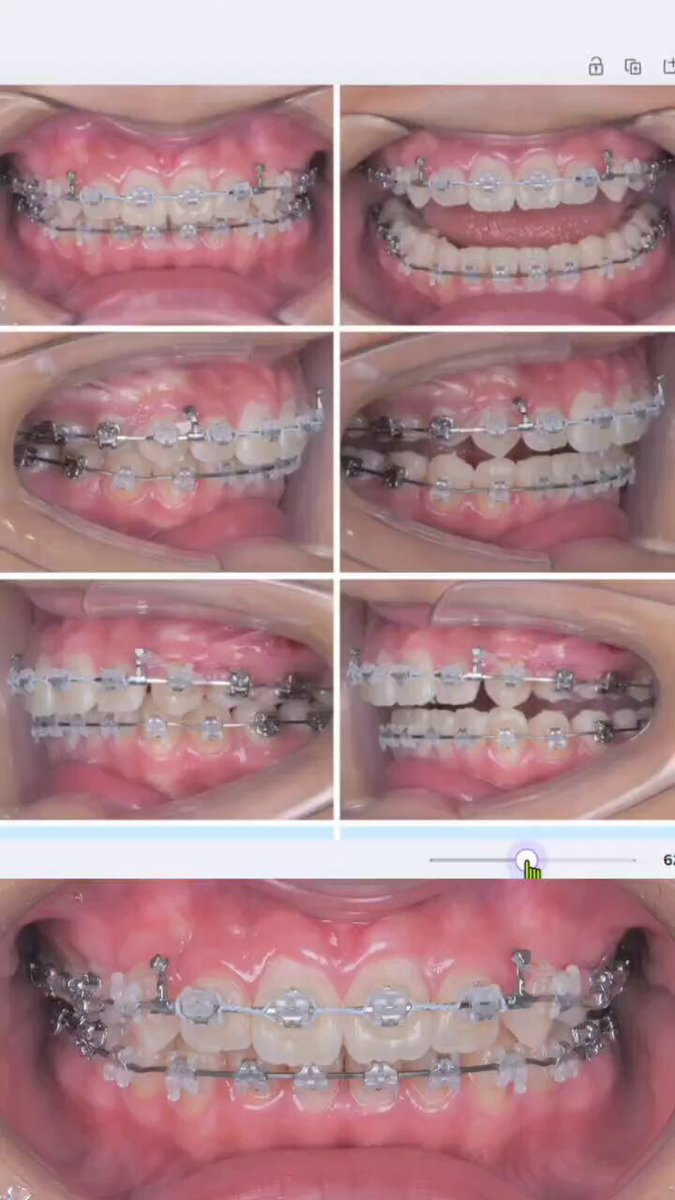 ⚠裁断済み　補綴と矯正 ドクターK 矯正医 (@orthodontistDrK) / X